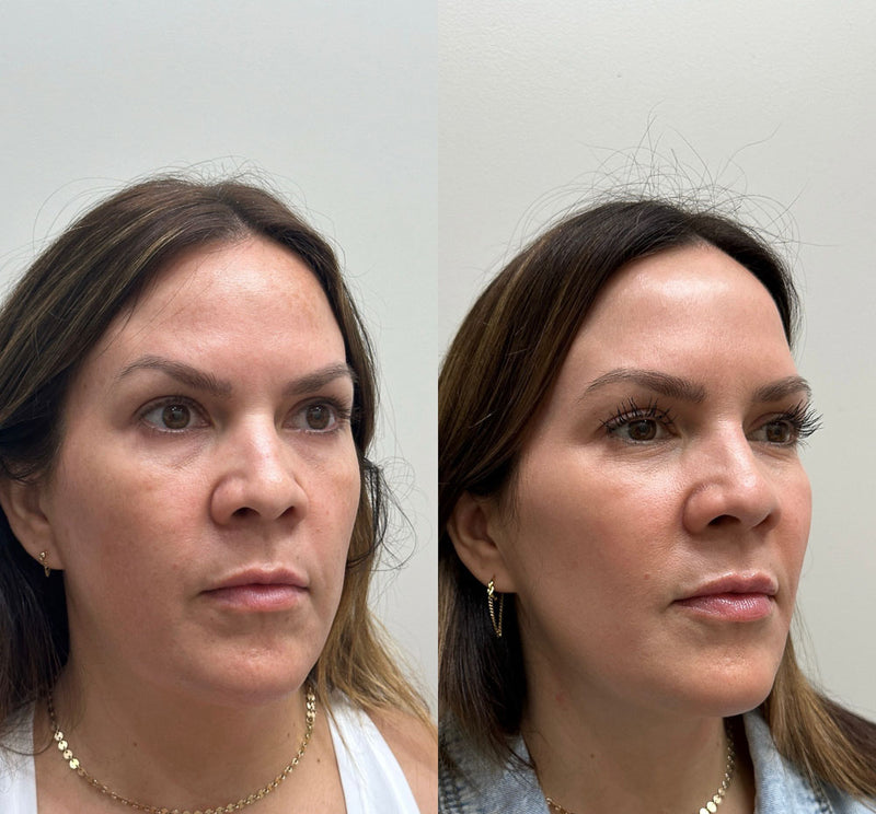Réduction Des Imperfections